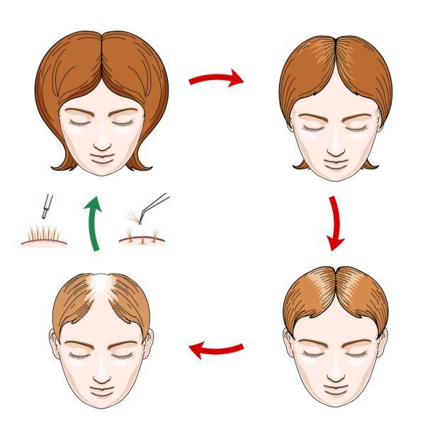 Causes of Hair Loss in Women | Trichologist Clinic : Hair & Scalp  Specialist Singapore | TK Trichokare