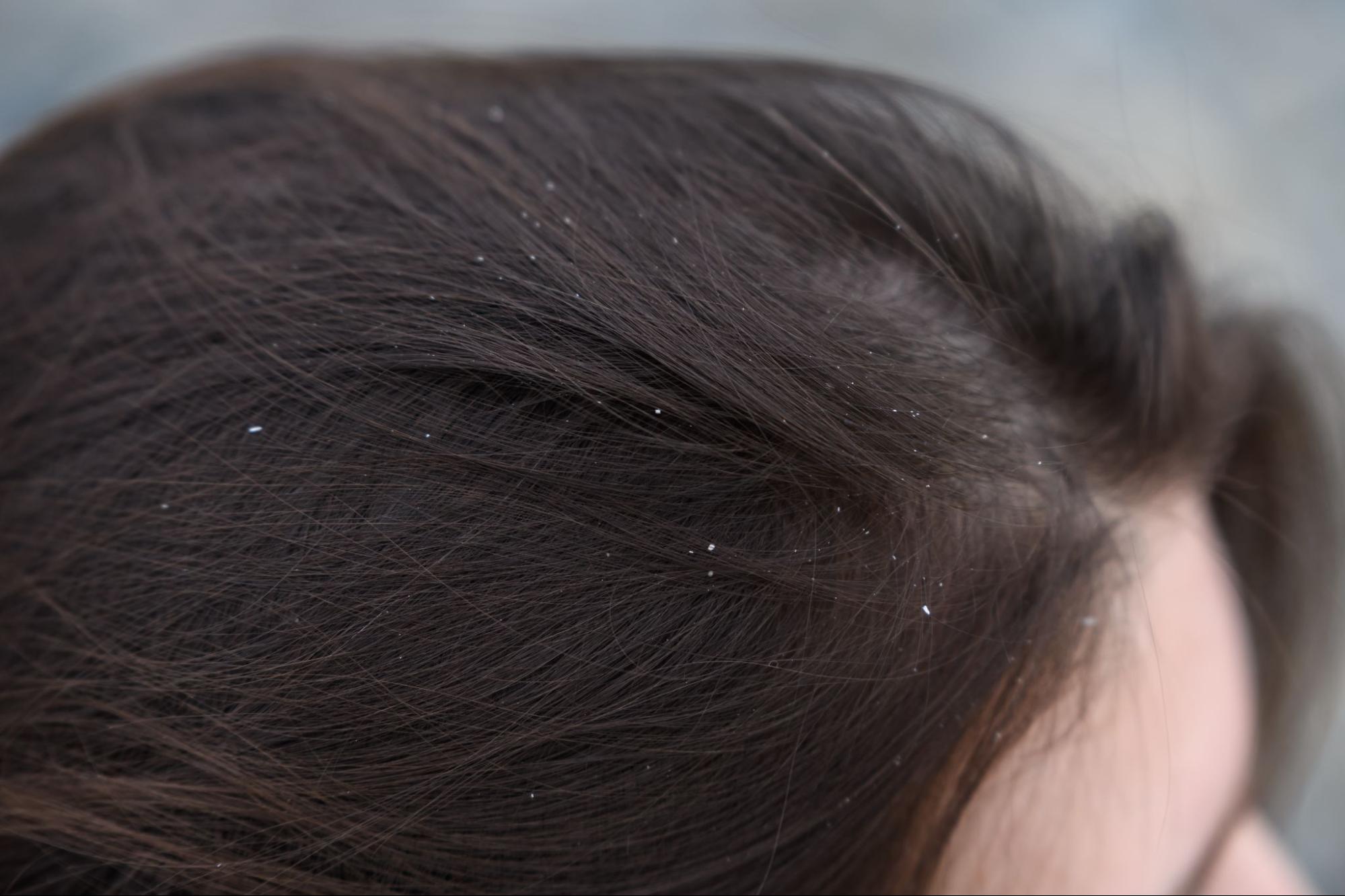 Persistent Scalp Irritation or Itchiness