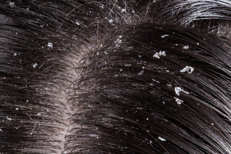 Could Dandruff Be Causing Your Hair Loss?