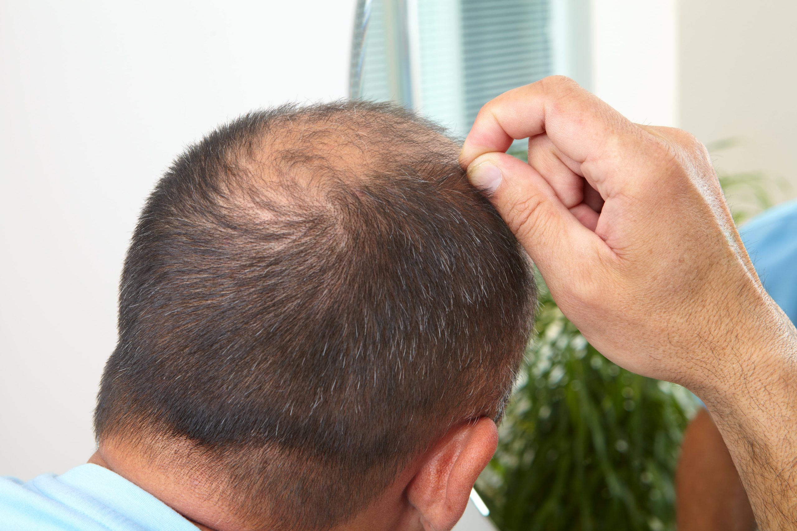 Is Dandruff Causing Your Hair Loss?