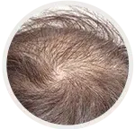 Ageing Scalp