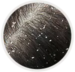 Dandruff