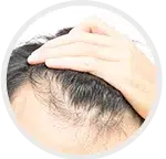 Hair Loss